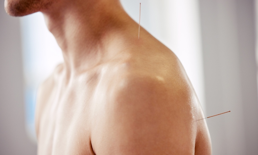 Acupuncture therapy
